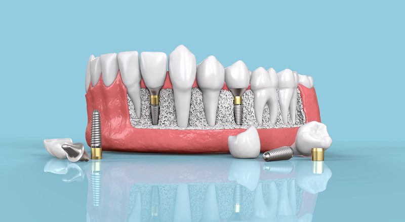 بهترین متخصص ایمپلنت در غرب تهران چه ویژگی هایی دارد؟