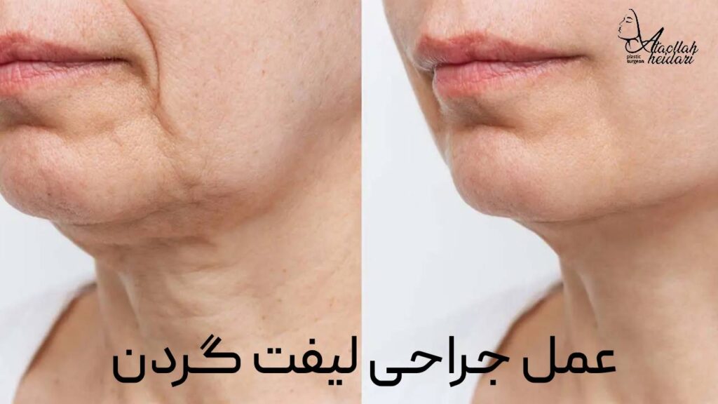 عکس عمل لیفت گردن