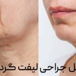 عمل لیفت گردن چگونه است؟ عوارض و ماندگاری لیفت گردن