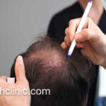 تخفیف ویژه کاشت موی طبیعی در تهران