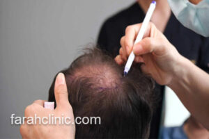 تخفیف ویژه کاشت موی طبیعی در تهران فرح کلینیک
