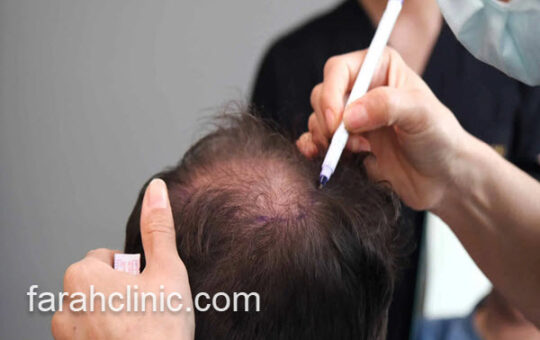 تخفیف ویژه کاشت موی طبیعی در تهران فرح کلینیک