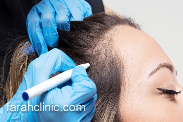 مزایای انجام کاشت مو طبیعی فرح کلینیک